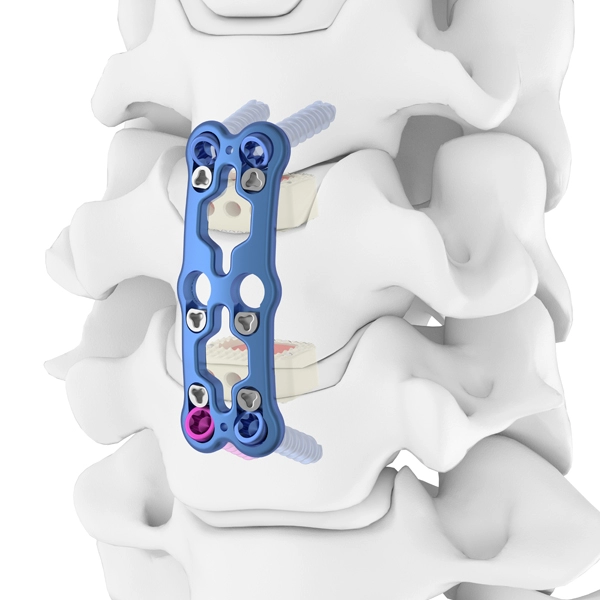 Placca per colonna vertebrale cervicale anteriore Ⅲ