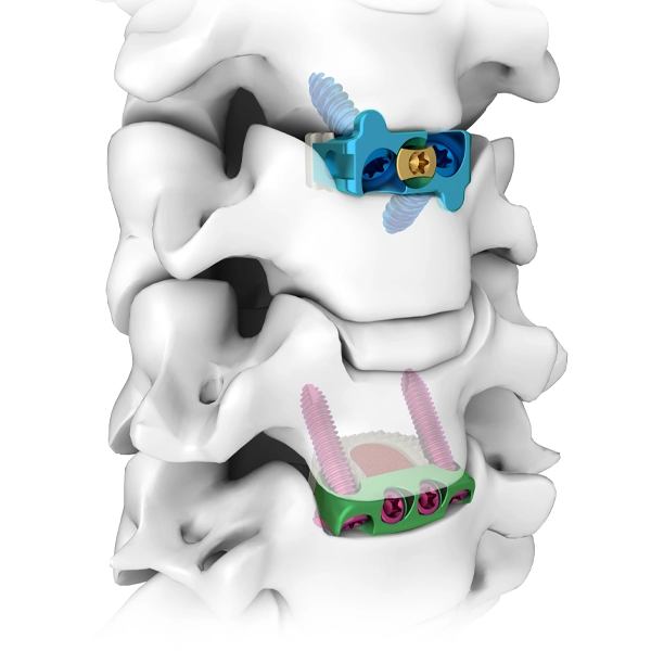 Piastra di bloccaggio intervertebrale cervicale anteriore a profilo zero e sistema combinato di gabbia