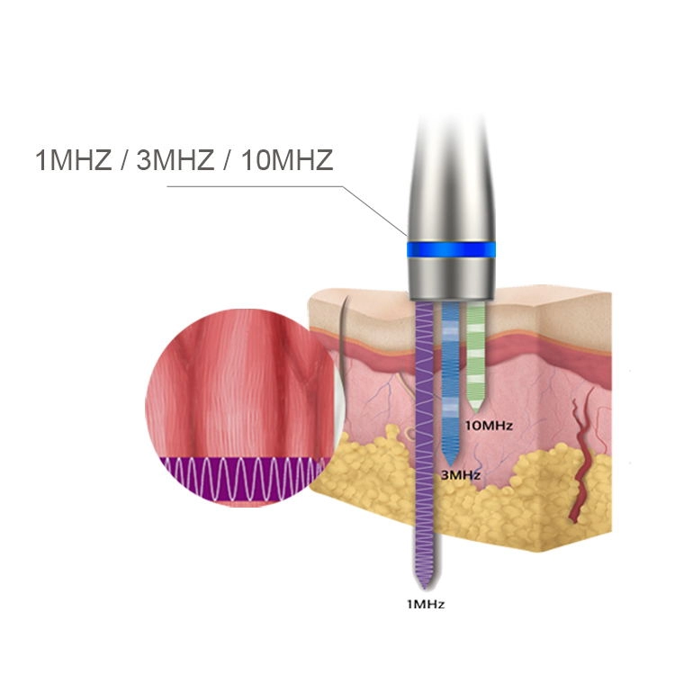 Ultrasuoni LDM Noblesse 10MHz Terapia 3 in 1 Ultrasuoni Sin Wrinkle Rimuovere Beauty Machine Attrezzature per la cura del viso con onde ultrasoniche ad alta frequenza